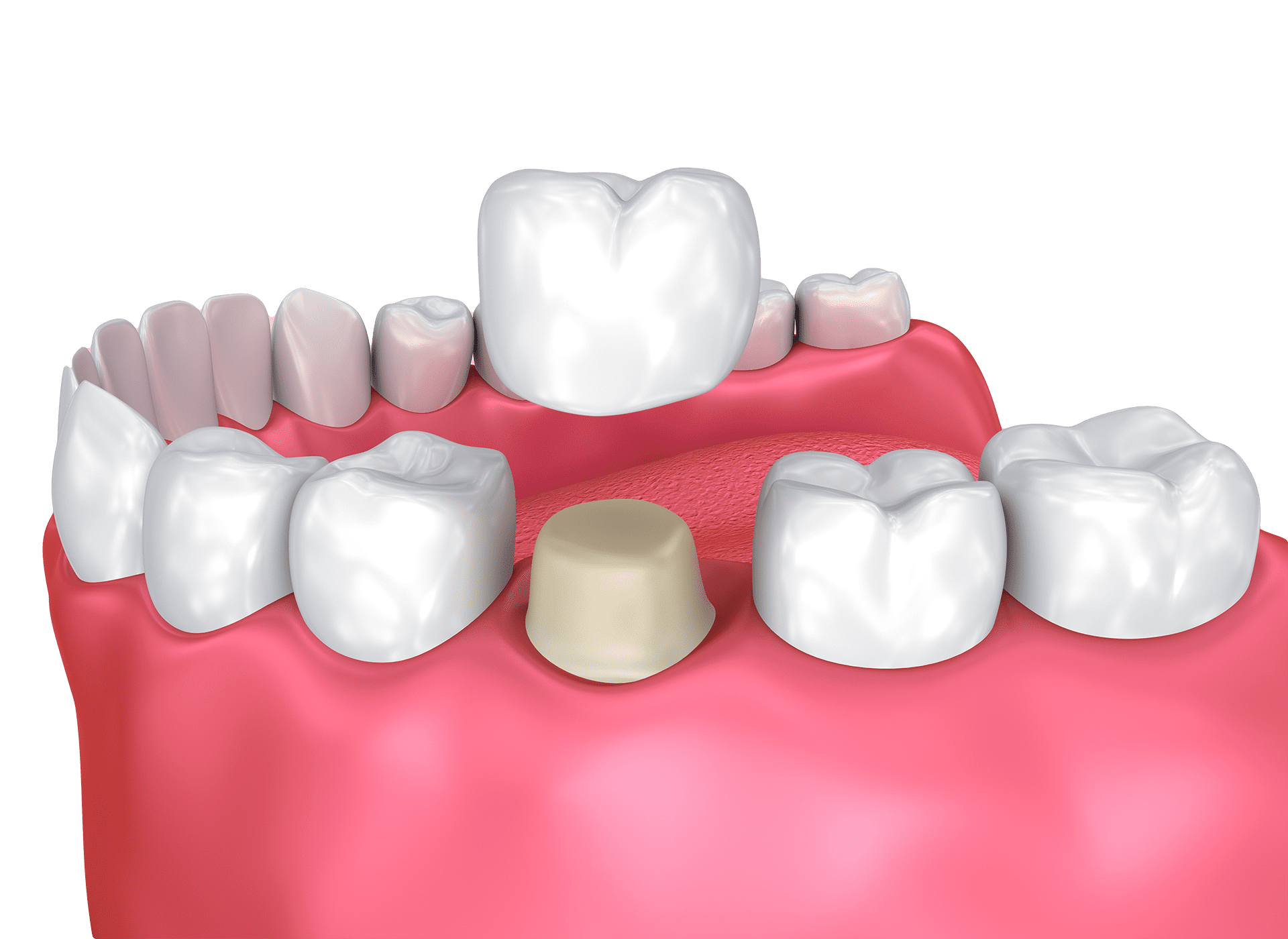 Anniston, AL & Woodland, AL - dental crowns